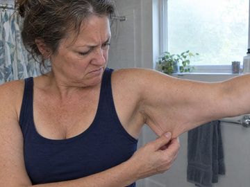 Loose skin under the upper arm